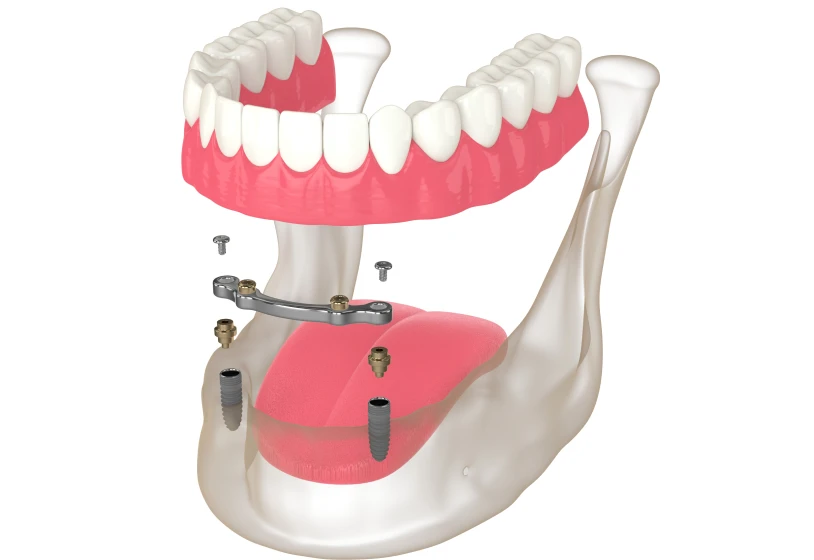 Dentaire implants Paris