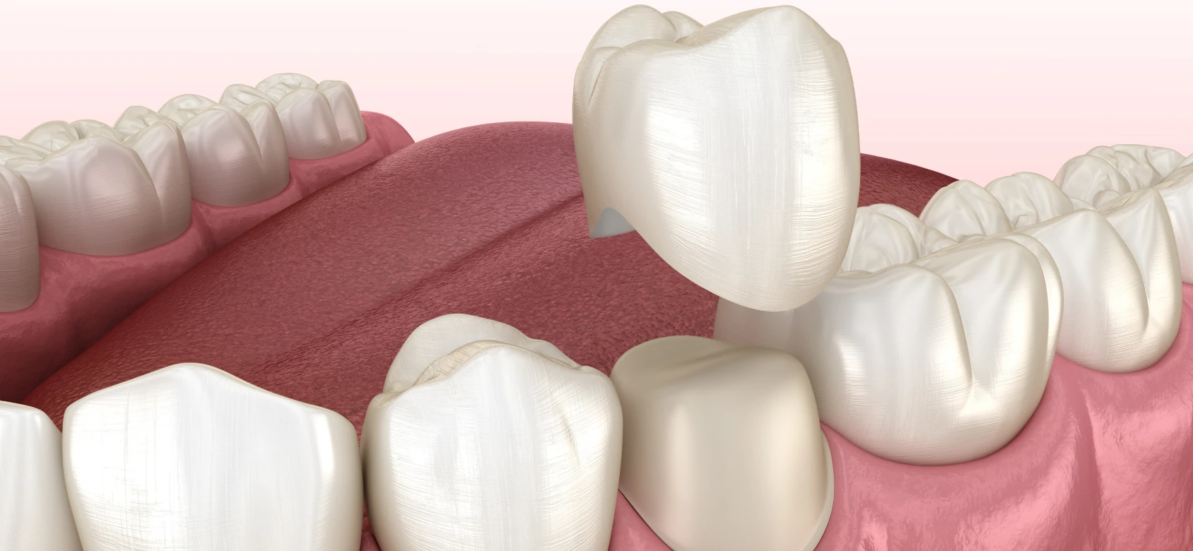 Couronnes en céramique á Croissy