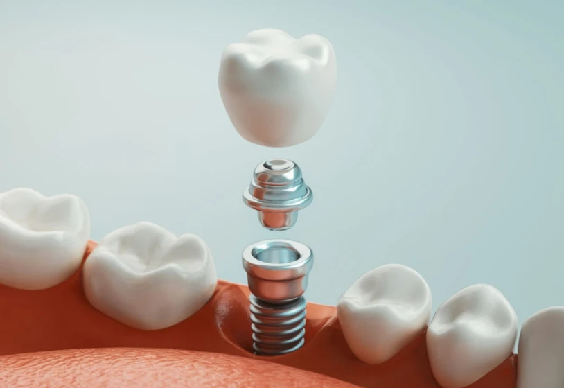 Implantologie au cabinet Claude Monet á croissy