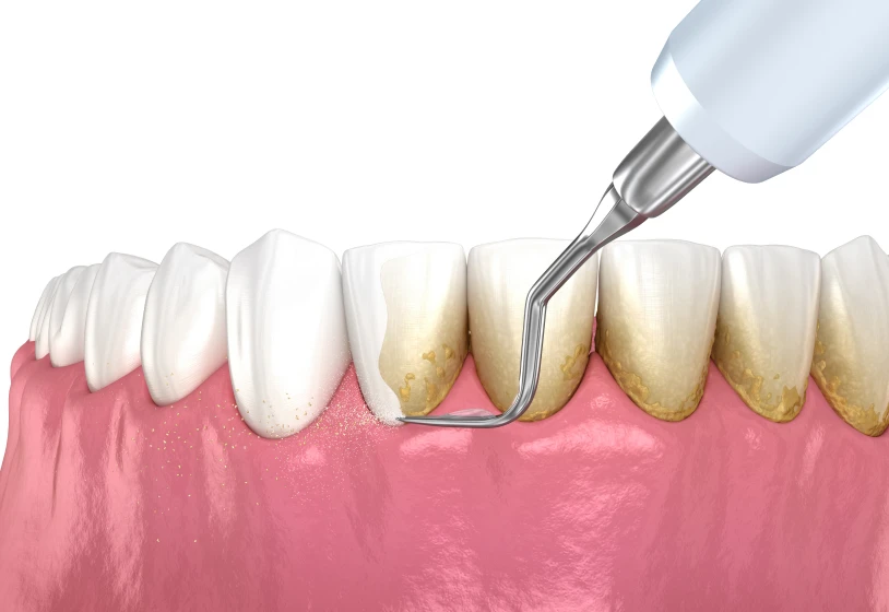 traitment parodontales  á Croissy