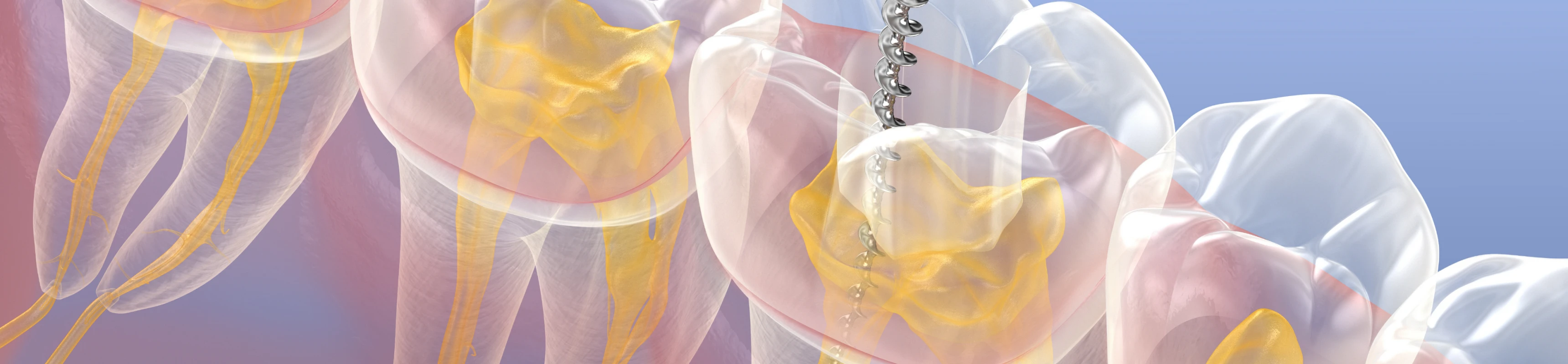 Endodontie au cabinet Dentaire Claude Monet à Croissy-sur-Seine