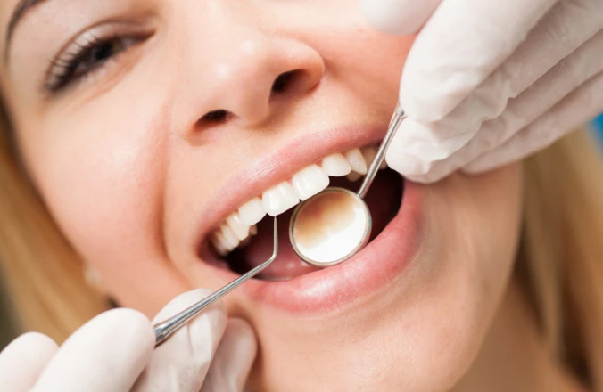 Les caries au cabinet Dentaire Claude Monet à Croissy-sur-Seine