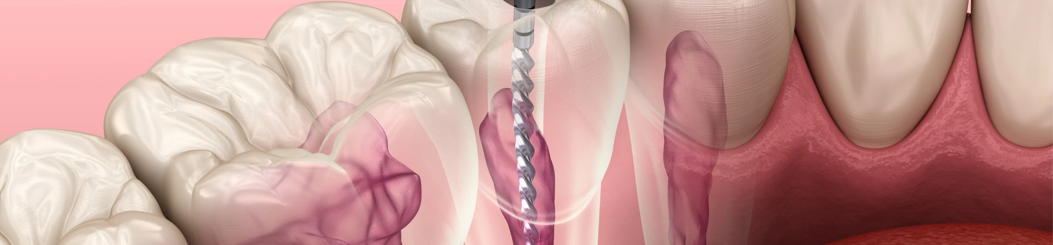 Dévitalisation au cabinet Dentaire Claude Monet à Croissy-sur-Seine