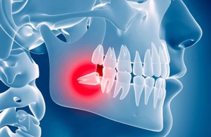 Dents de sagesse au cabinet Dentaire Claude Monet à Croissy-sur-Seine