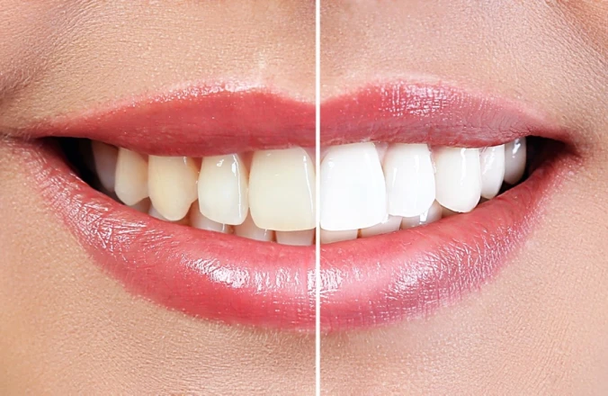 Comment combattre les dents jaunes ?