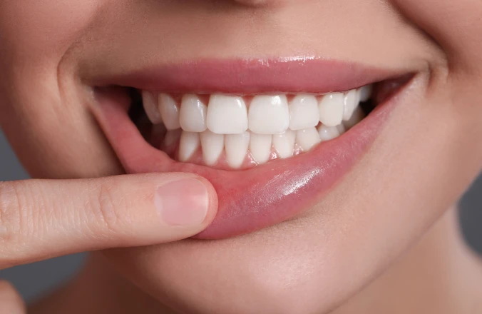 Reconnaître et traiter la récession gingivale
